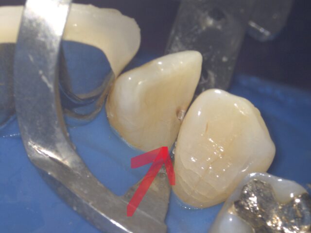 右上2番目の間の虫歯 - 練馬の歯医者「いき歯科医院」